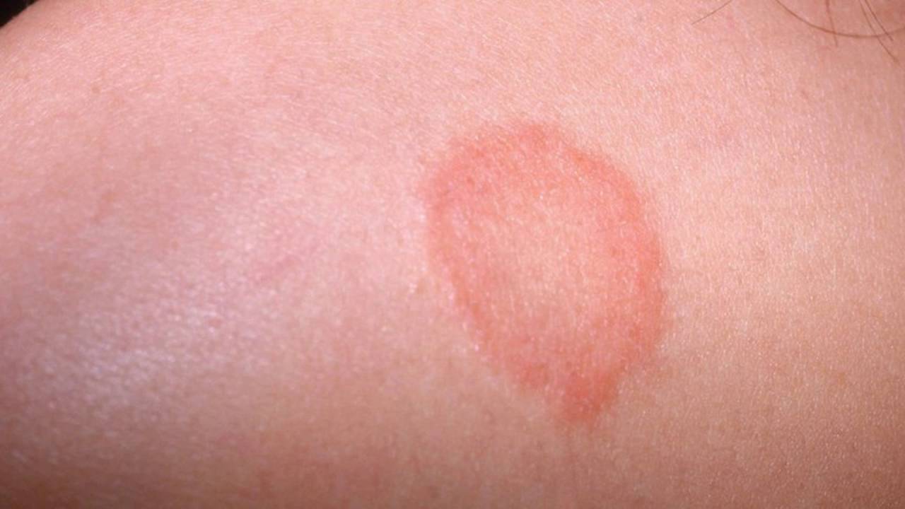 Simptomele si tratamentul eczemelor