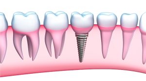 Implanturi_dentare_fastandfixed